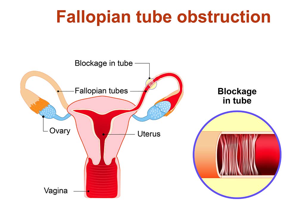 What Happens During Chromotubation Procedure